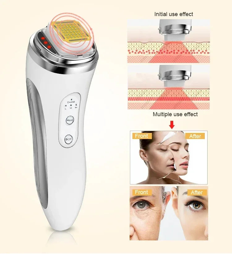 RF Face Lifting Device – Dot Matrix Beauty Massager for Wrinkle Removal & Skin Tightening